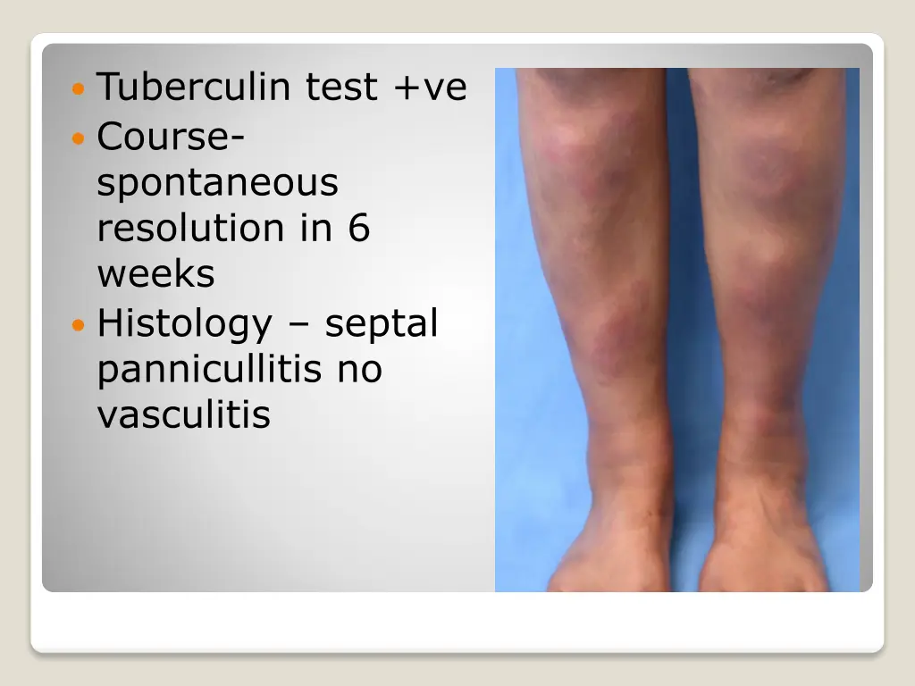 tuberculin test ve course spontaneous resolution