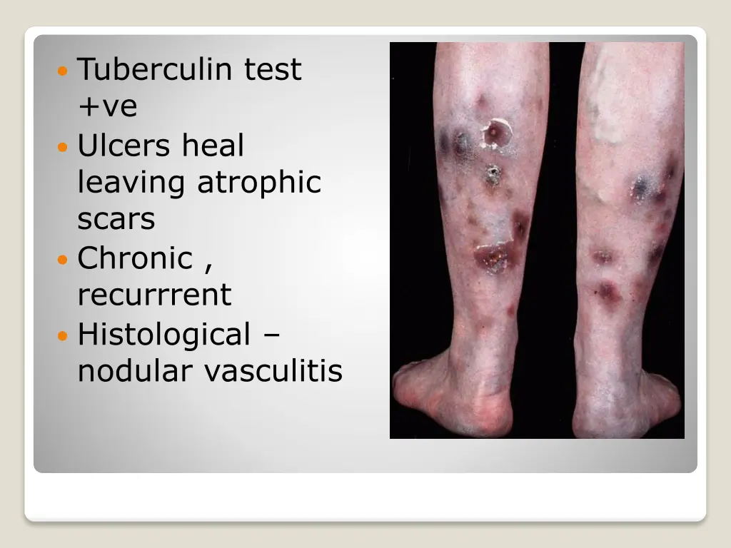 tuberculin test ve ulcers heal leaving atrophic