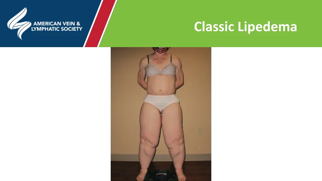 classic lipedema