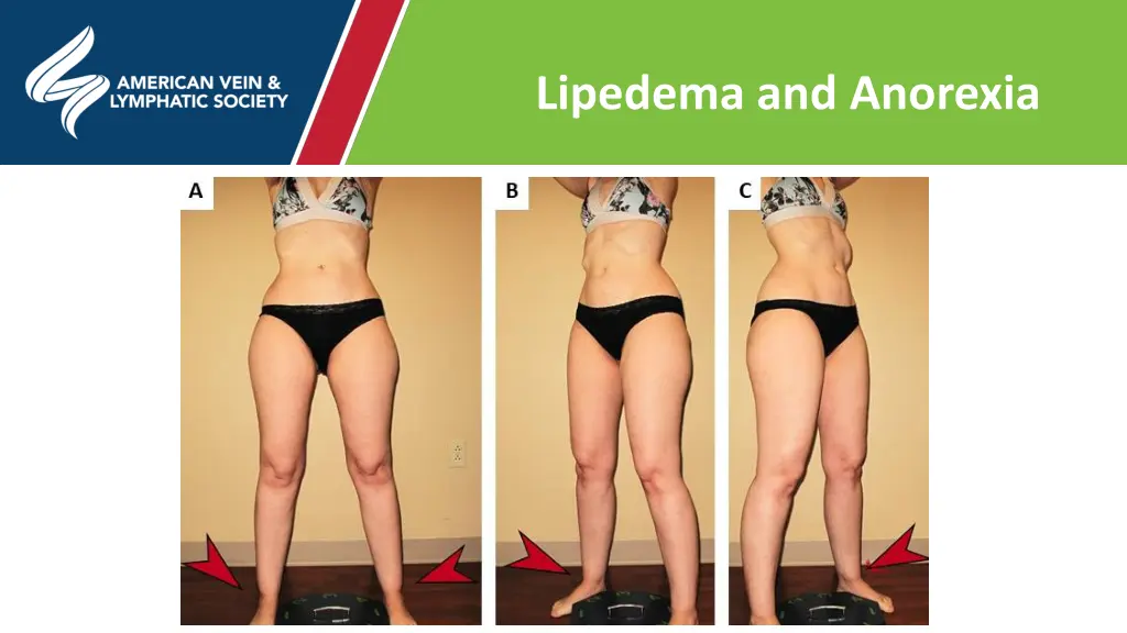 lipedema and anorexia