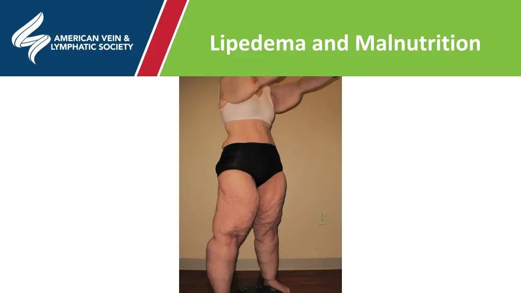 lipedema and malnutrition