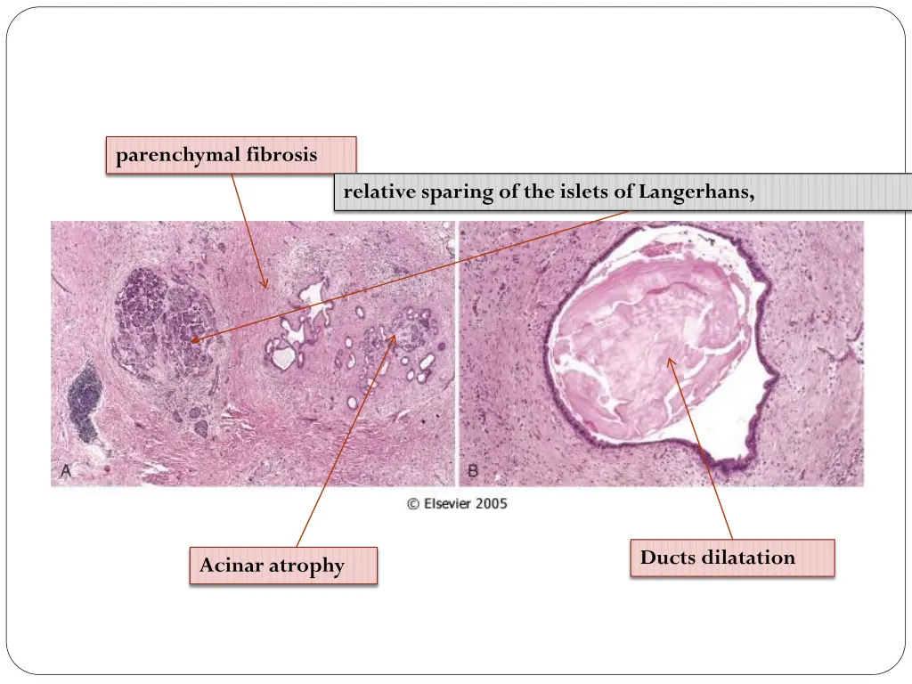 parenchymal fibrosis