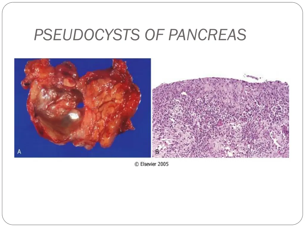 pseudocysts of pancreas 2