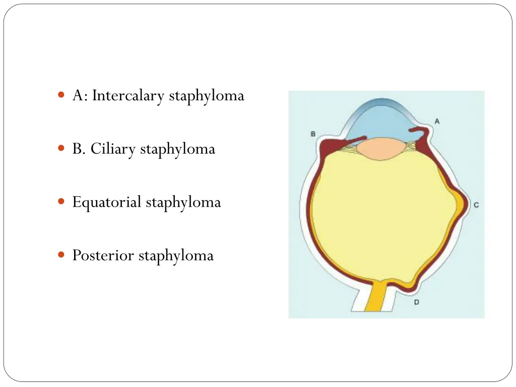 a intercalary staphyloma