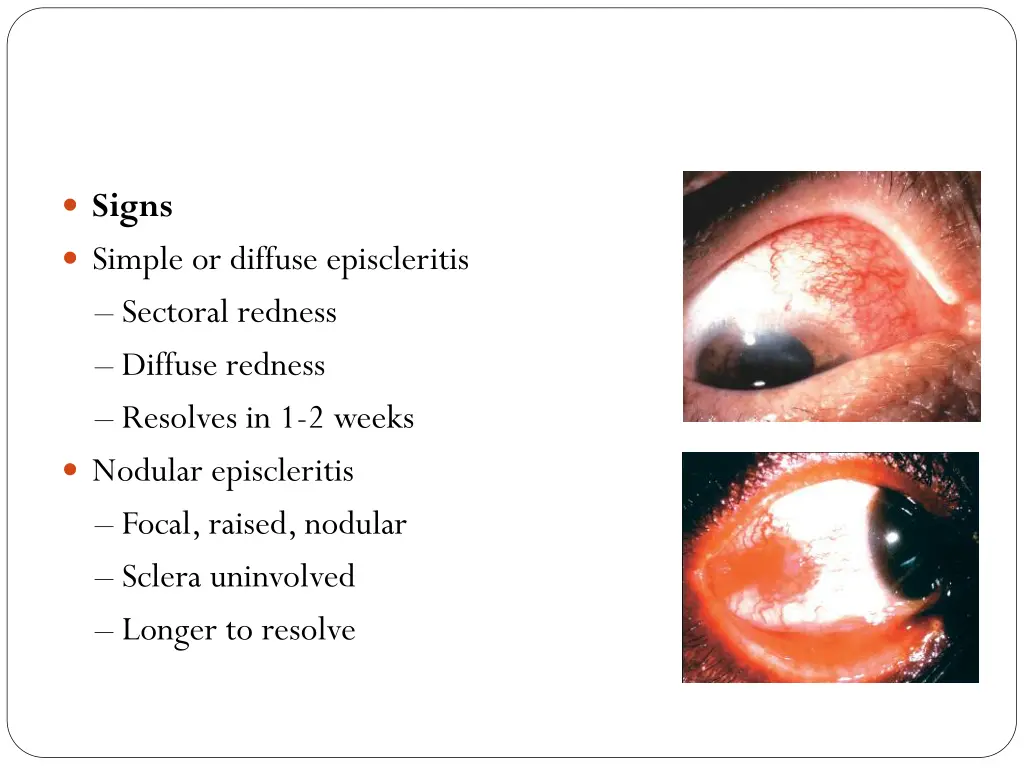 signs simple or diffuse episcleritis sectoral