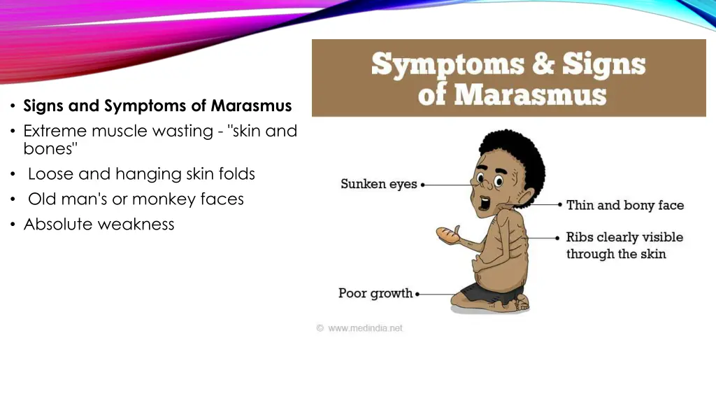 signs and symptoms of marasmus extreme muscle