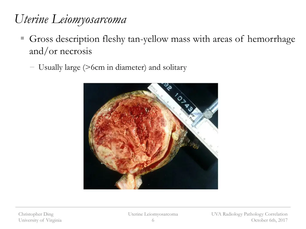 uterine leiomyosarcoma 1