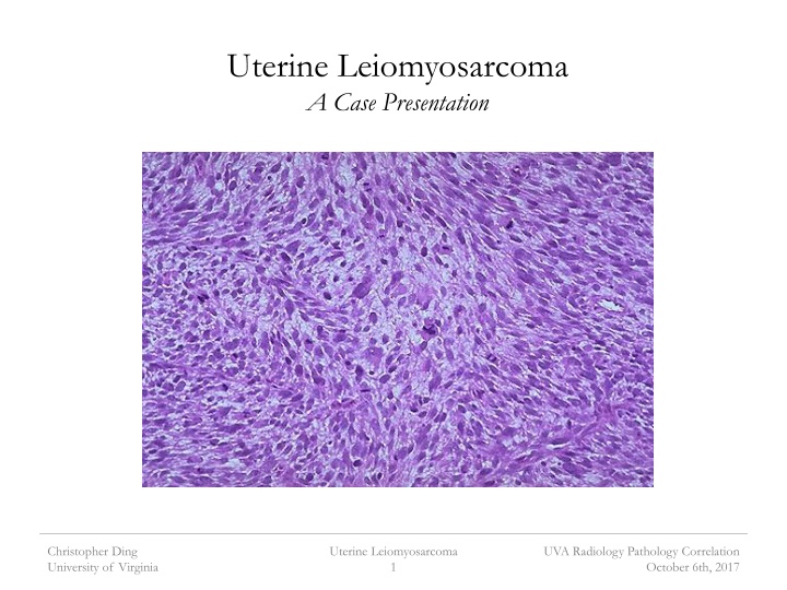 uterine leiomyosarcoma a case presentation