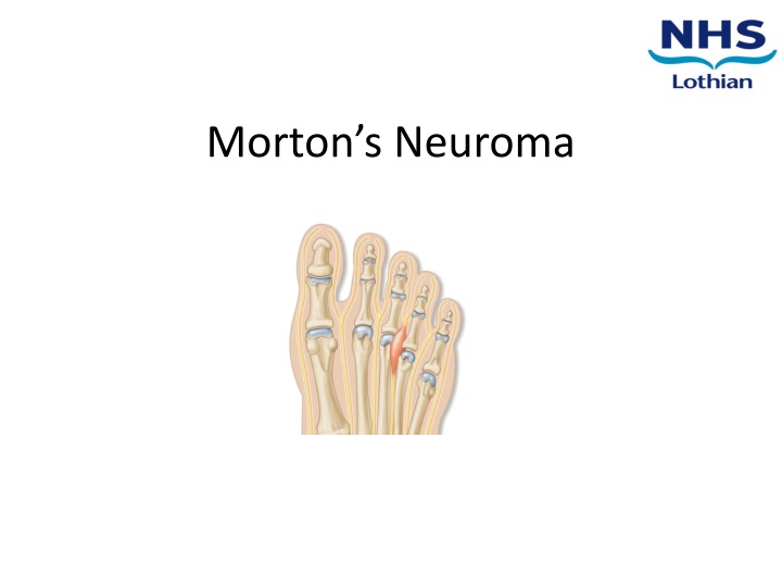 morton s neuroma