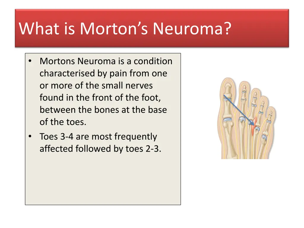 what is morton s neuroma