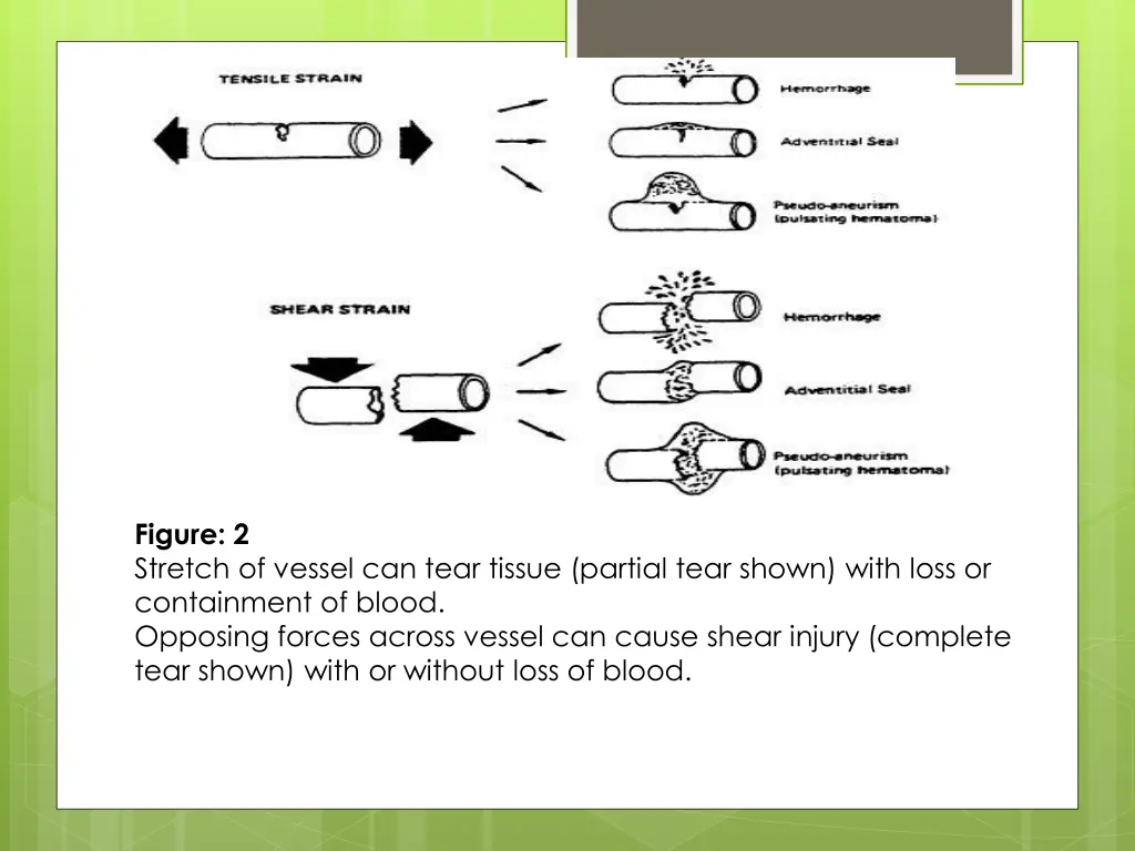 figure 2 stretch of vessel can tear tissue