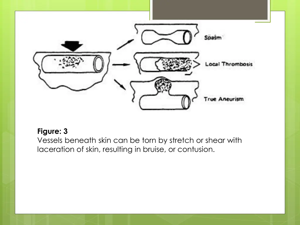 figure 3 vessels beneath skin can be torn