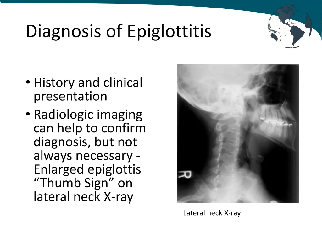 diagnosis of epiglottitis