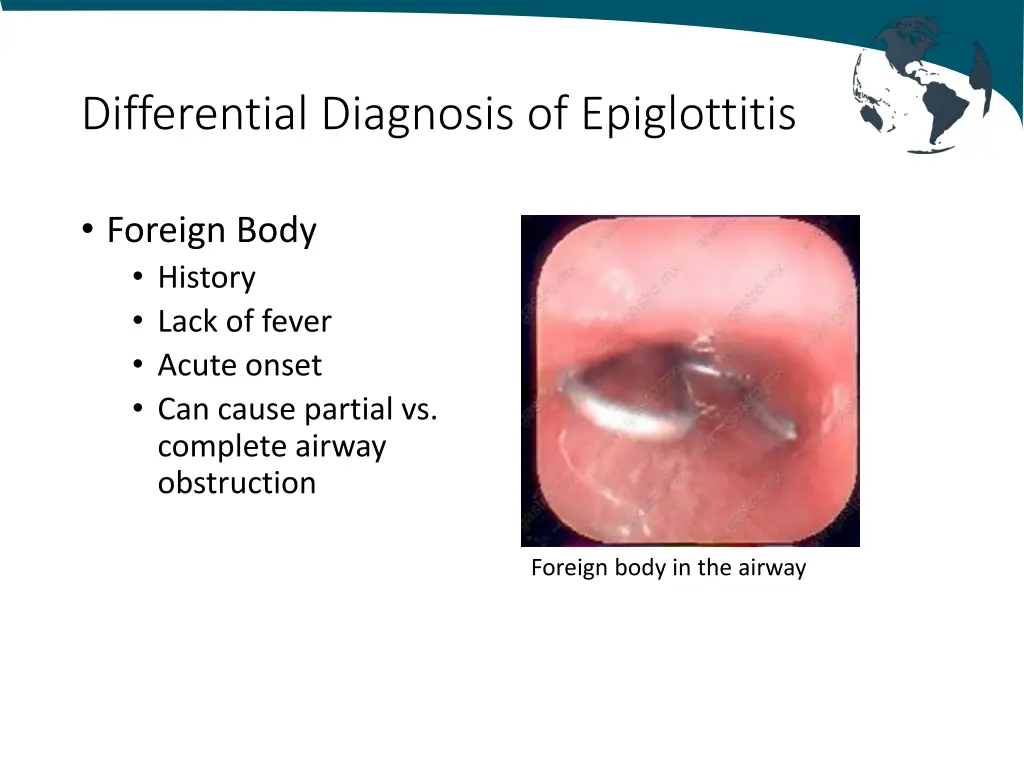 differential diagnosis of epiglottitis 3