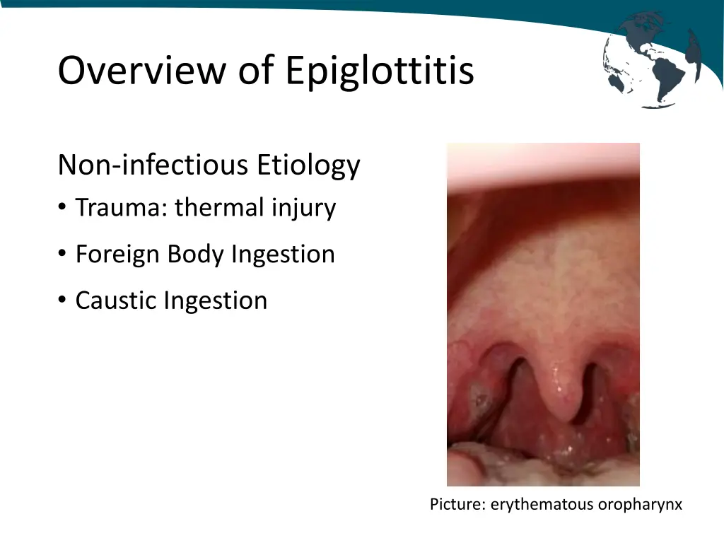 overview of epiglottitis 1