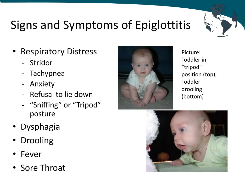 signs and symptoms of epiglottitis