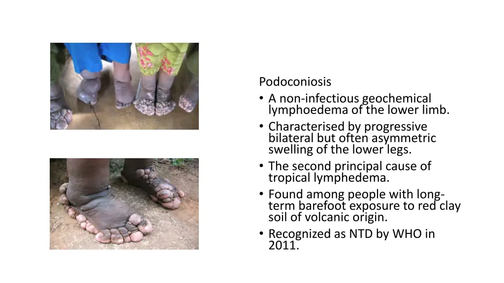 podoconiosis a non infectious geochemical