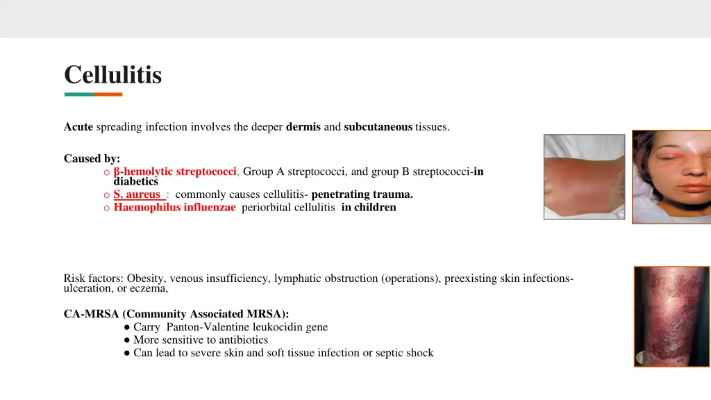 cellulitis