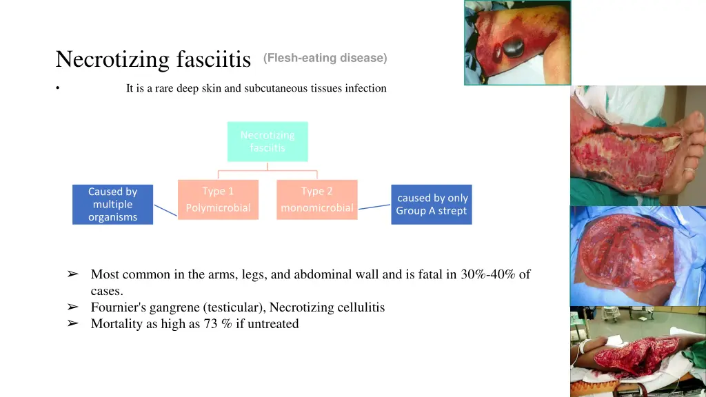 necrotizing fasciitis