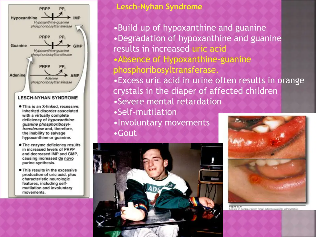 lesch nyhan syndrome