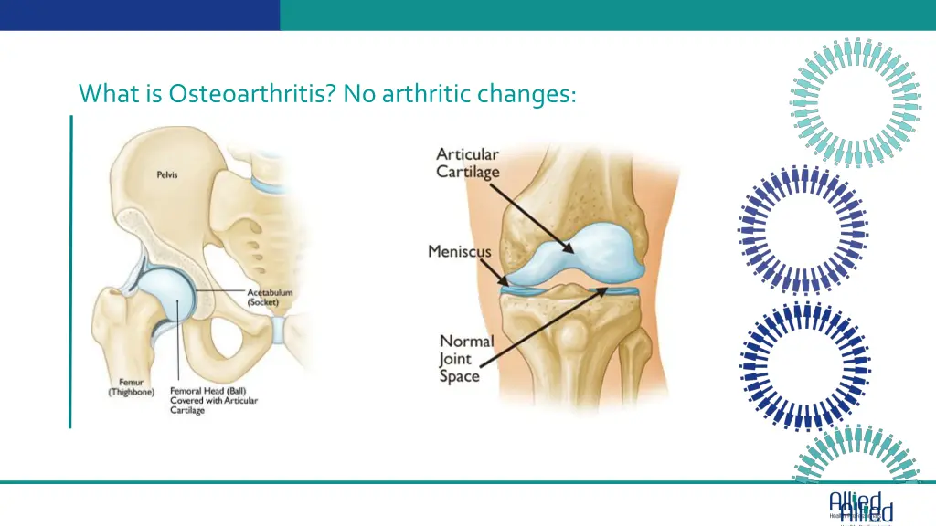 what is osteoarthritis no arthritic changes