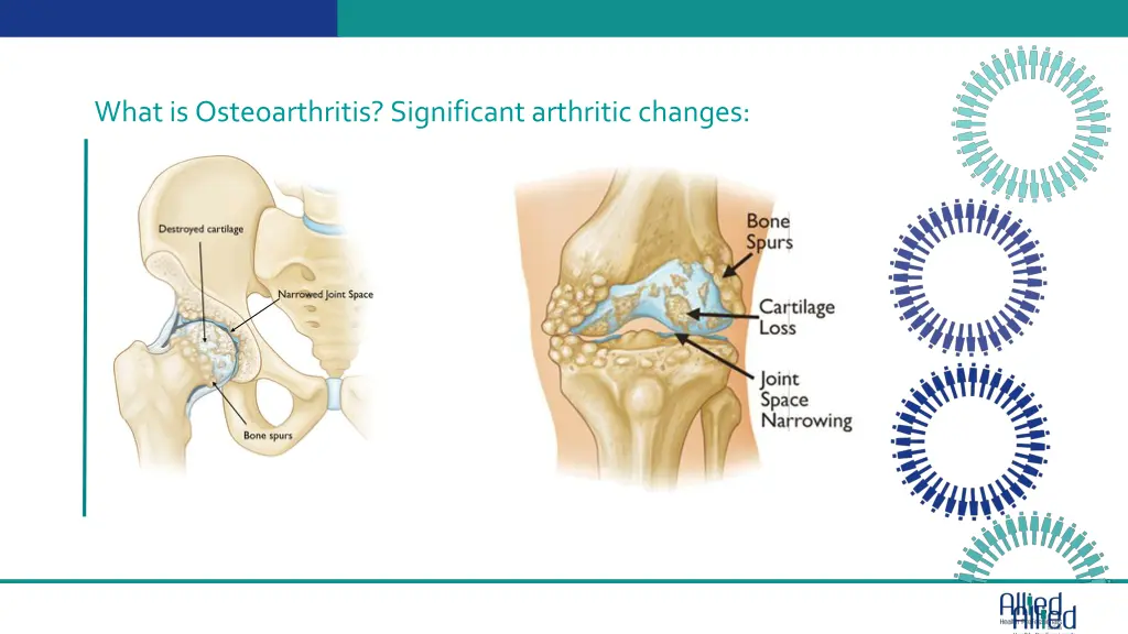 what is osteoarthritis significant arthritic