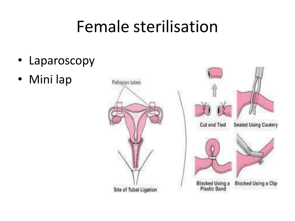 female sterilisation