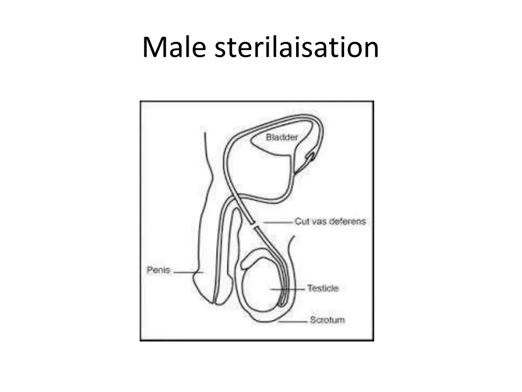 male sterilaisation