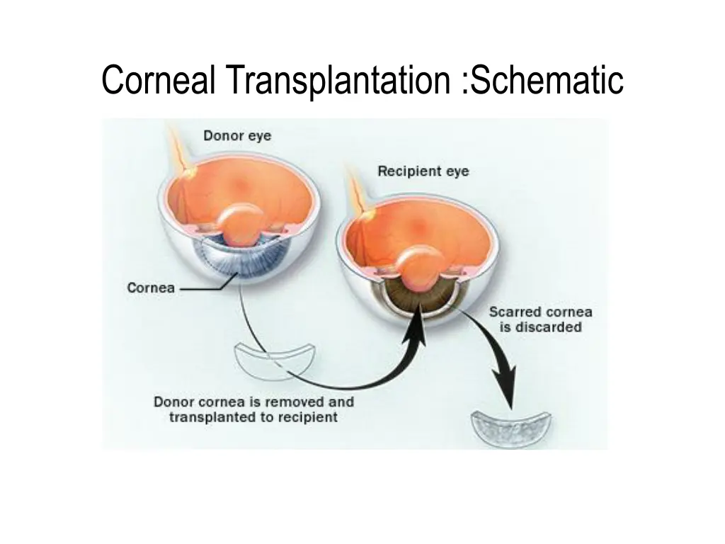 corneal transplantation schematic