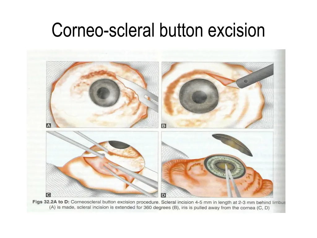 corneo scleral button excision