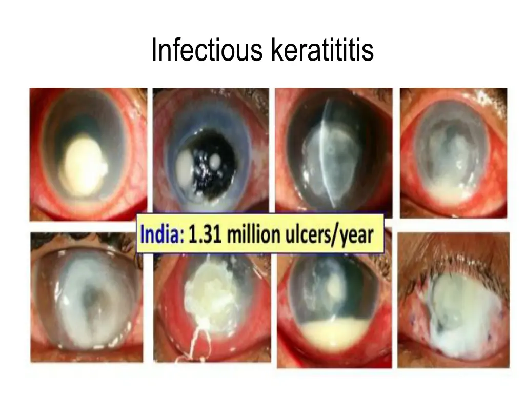 infectious keratititis