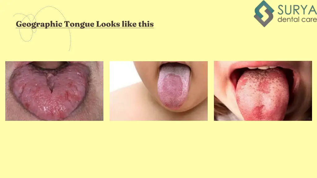 geographic tongue looks like this