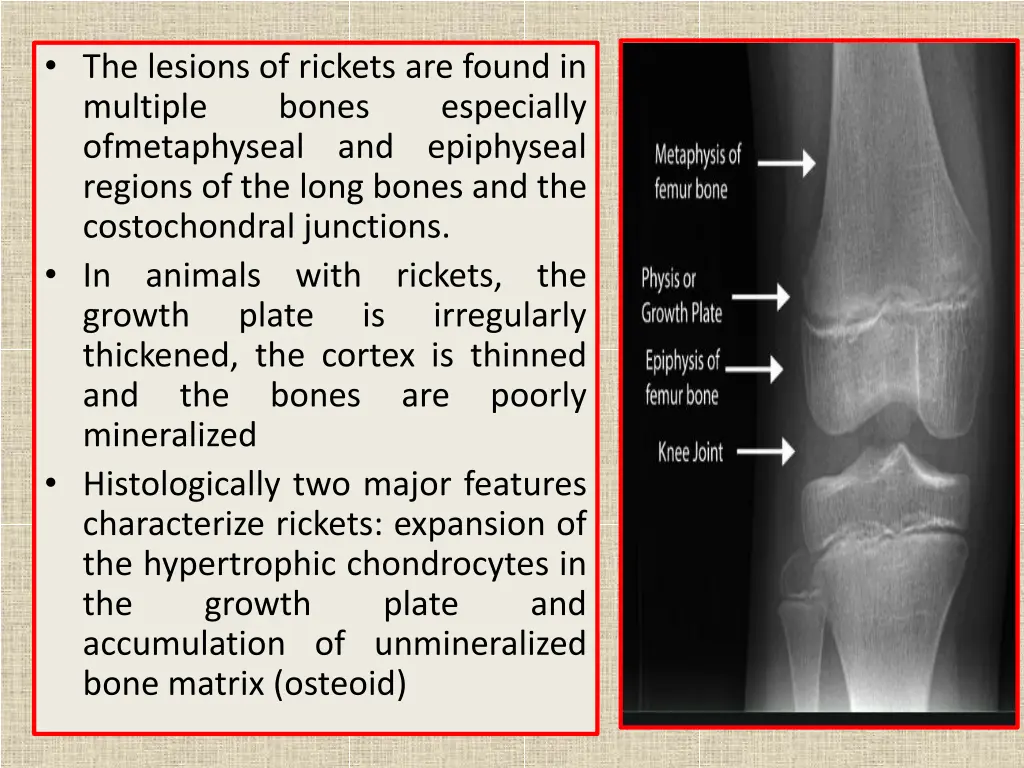 the lesions of rickets are found in multiple