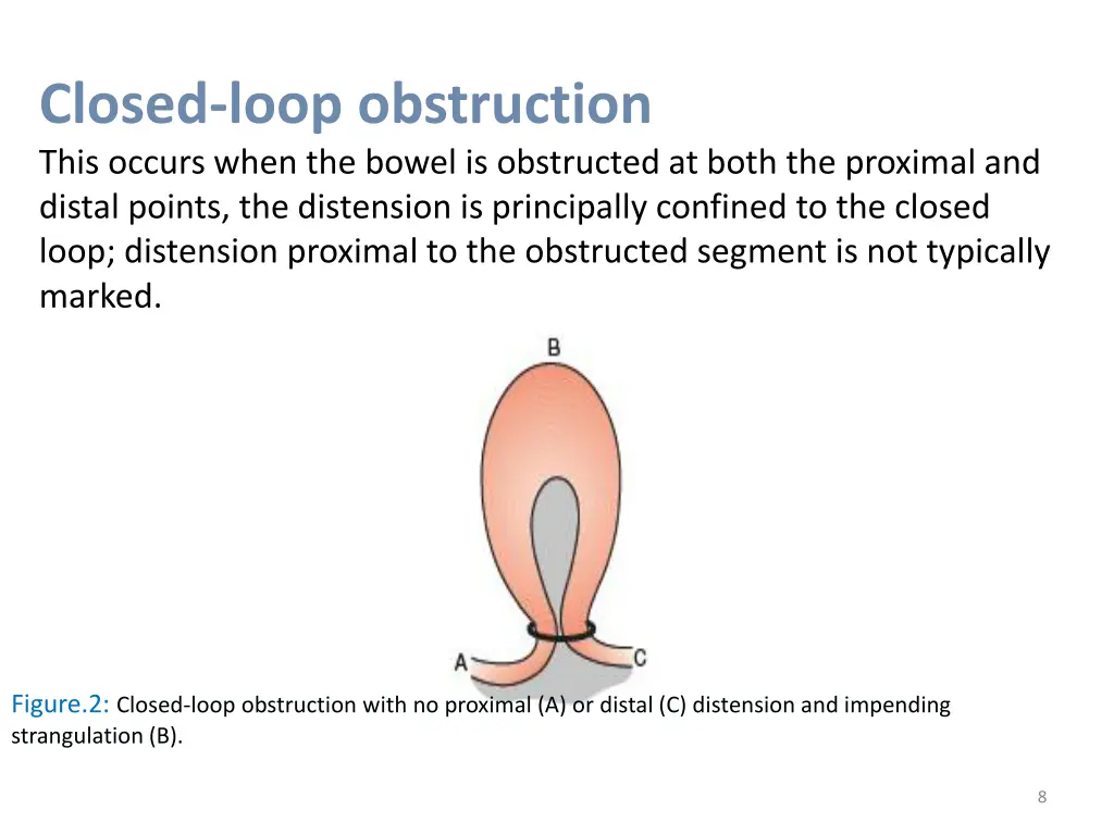 closed loop obstruction this occurs when