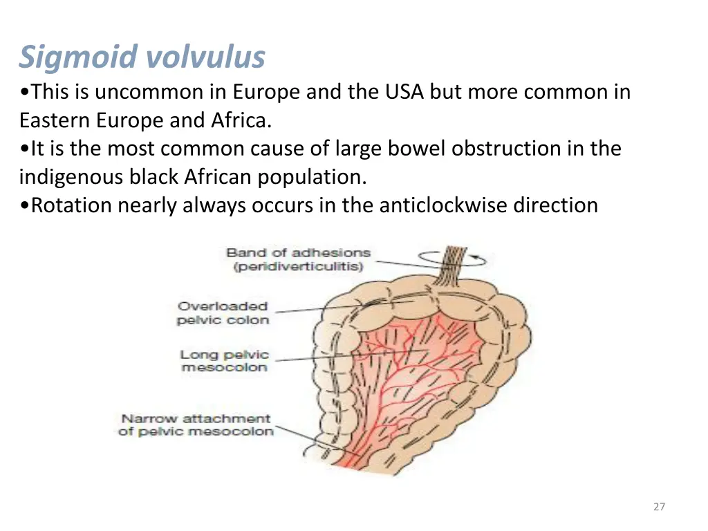 sigmoid volvulus this is uncommon in europe