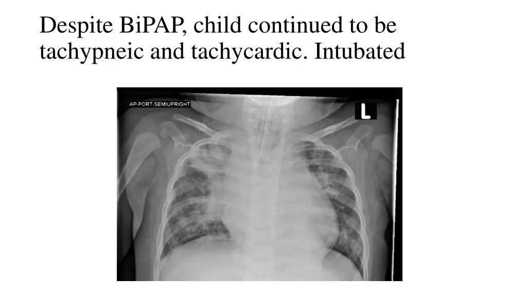 despite bipap child continued to be tachypneic