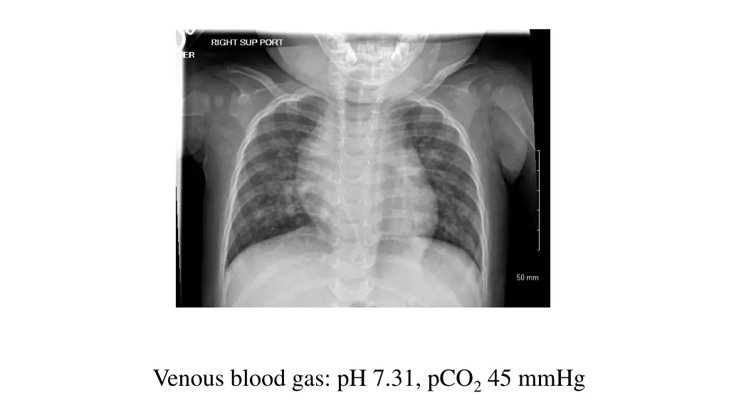 venous blood gas ph 7 31 pco 2 45 mmhg