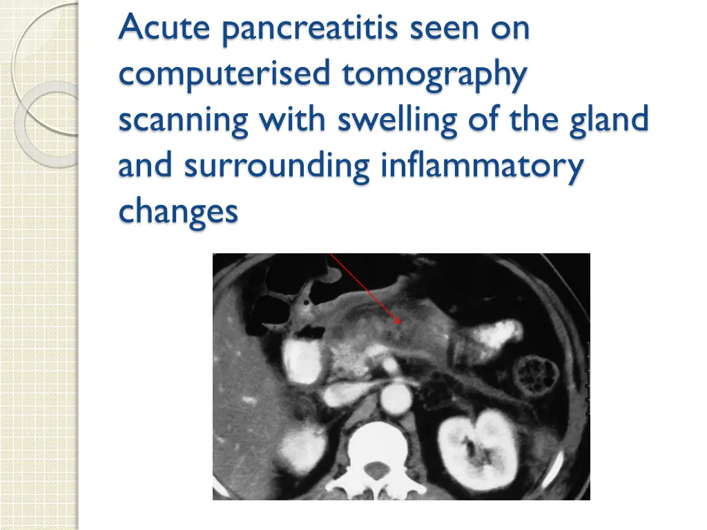 acute pancreatitis seen on computerised