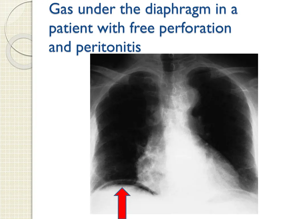 gas under the diaphragm in a patient with free