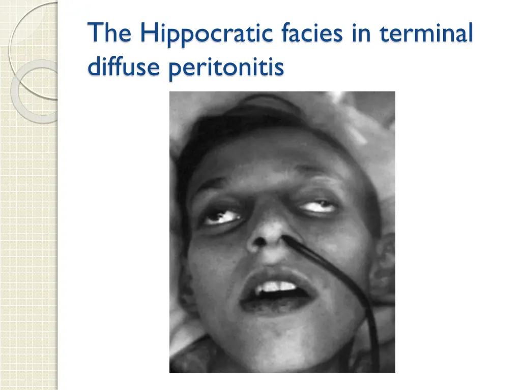 the hippocratic facies in terminal diffuse