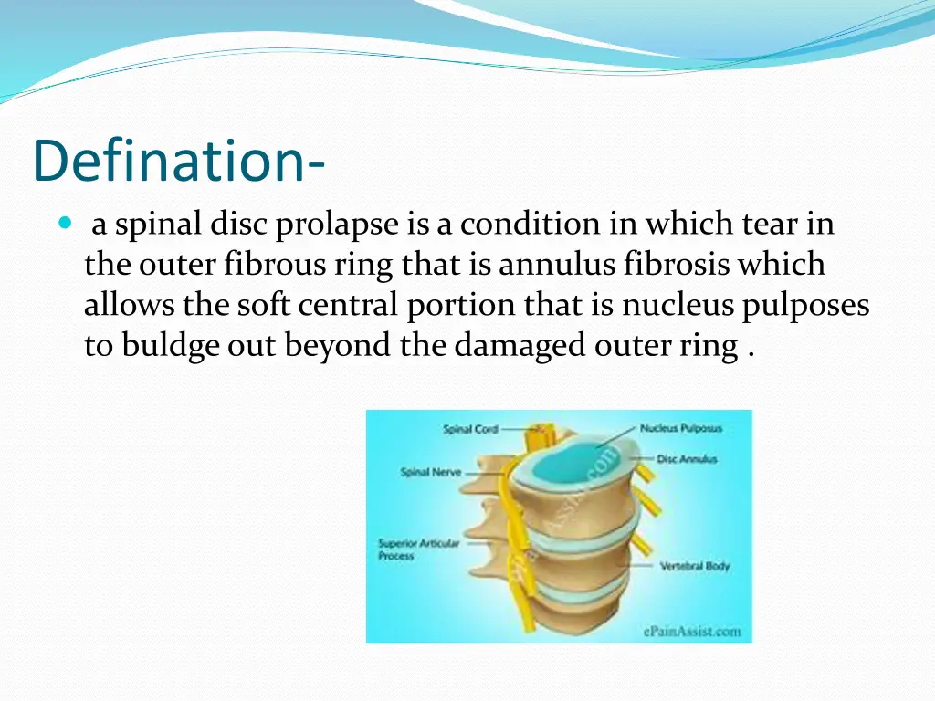 defination a spinal disc prolapse is a condition