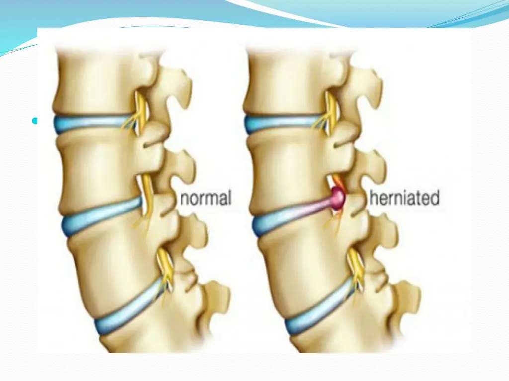 diagram of ivd