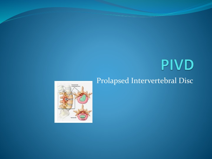 prolapsed intervertebral disc