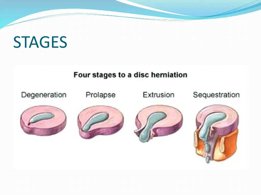 stages