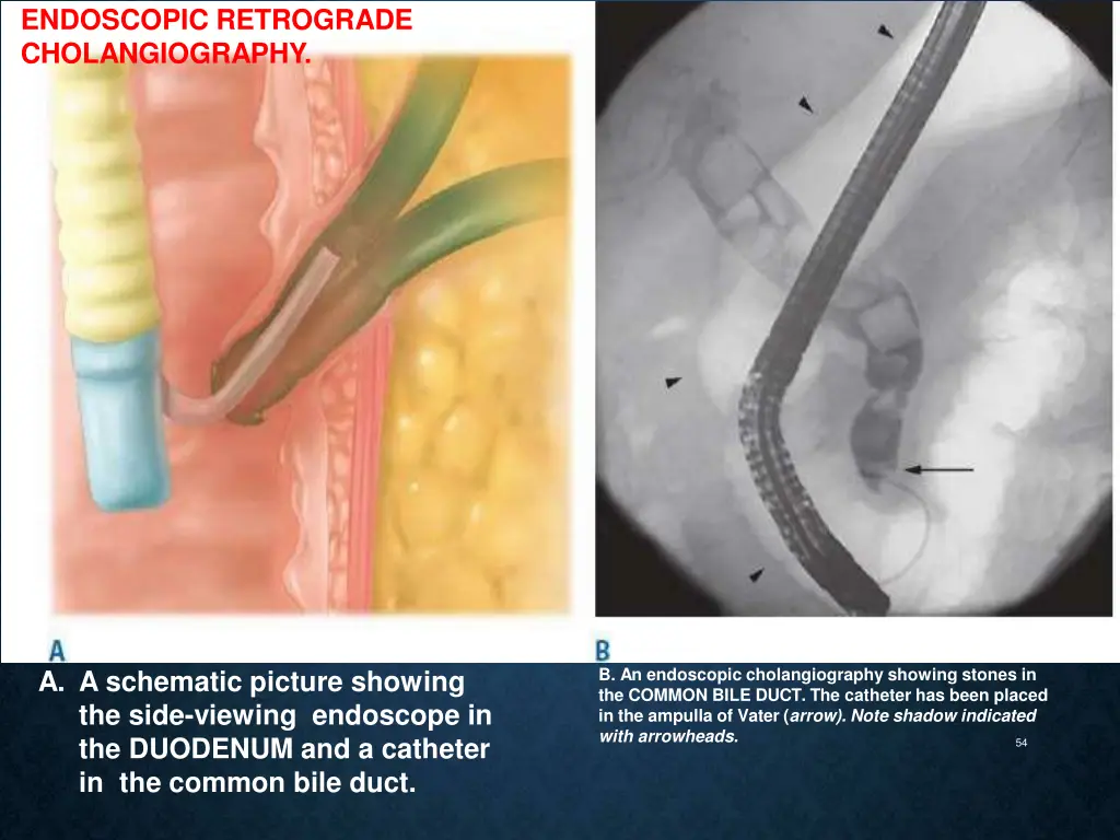 endoscopic retrograde cholangiography