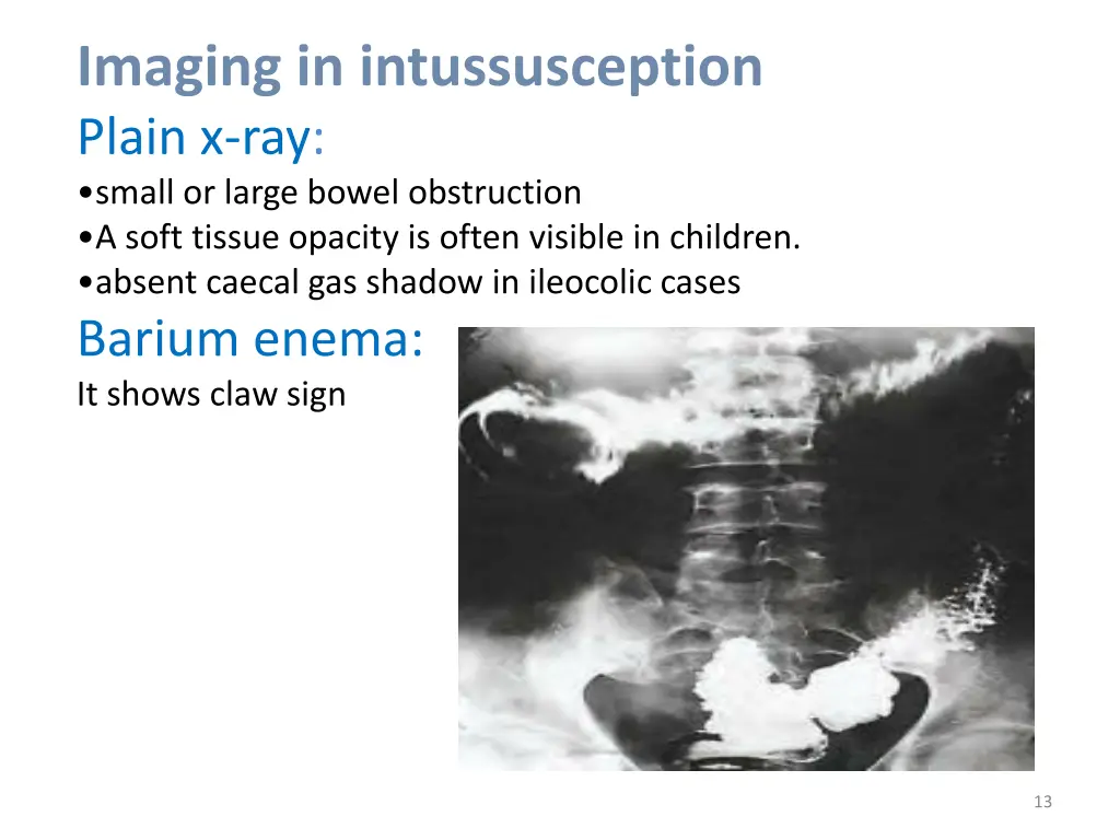 imaging in intussusception plain x ray small