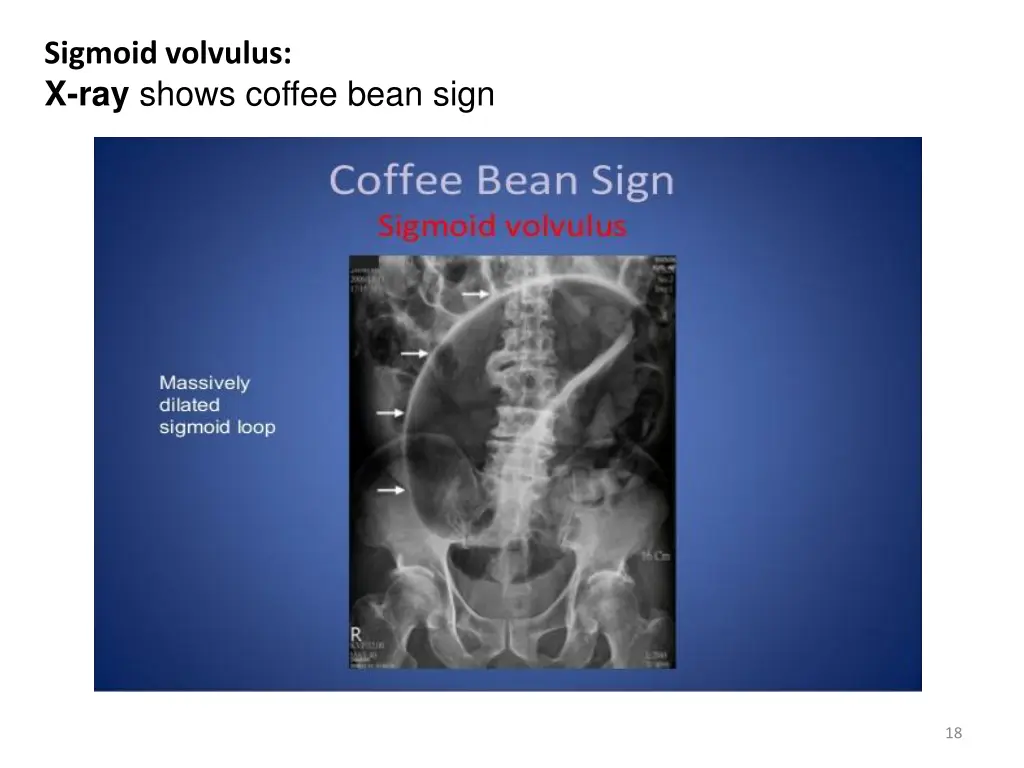 sigmoid volvulus x ray shows coffee bean sign