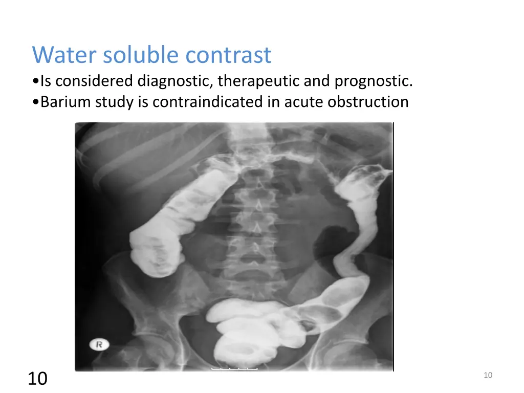 water soluble contrast is considered diagnostic