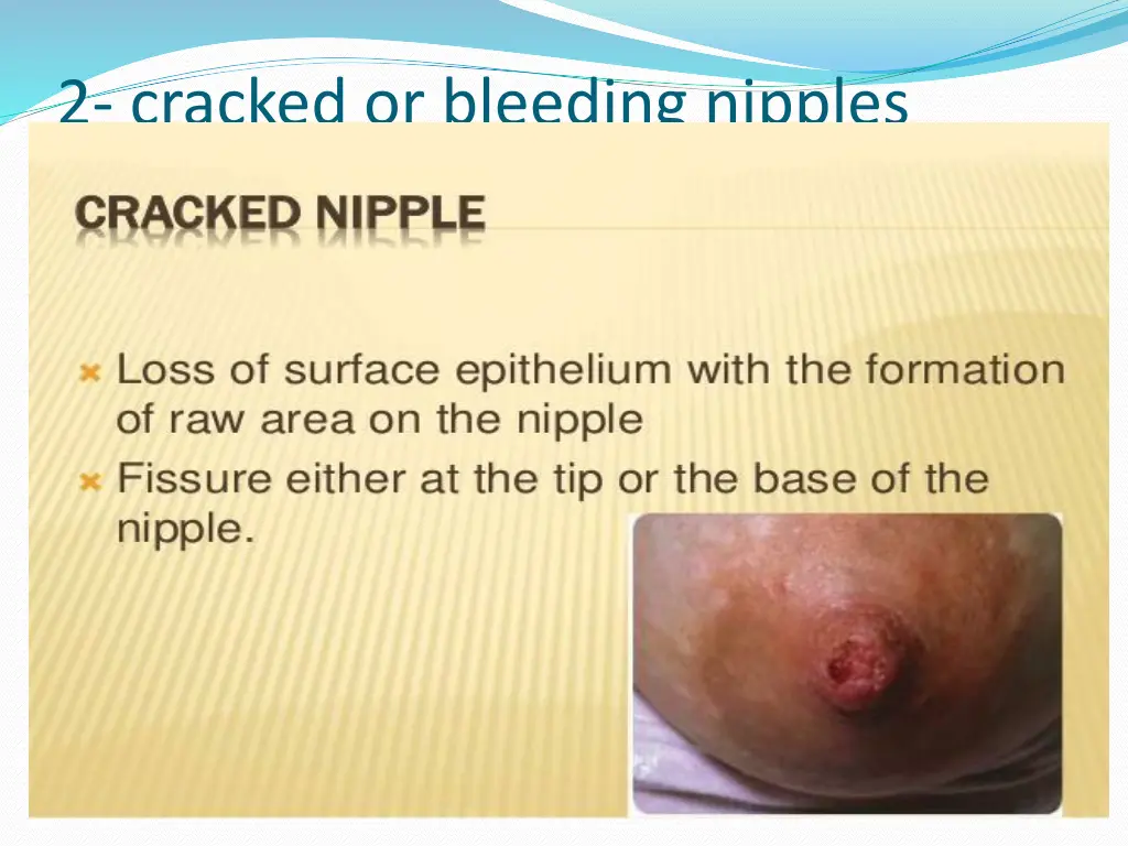 2 cracked or bleeding nipples