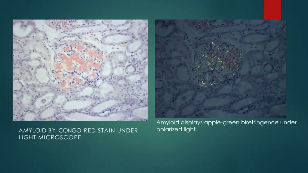 amyloid displays apple green birefringence under